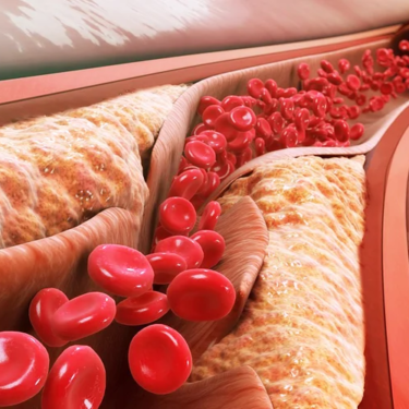 The Link Between High Cholesterol and Increased Risk of Heart Disease