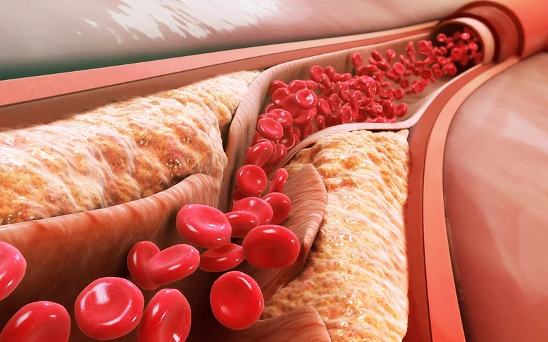 The Link Between High Cholesterol and Increased Risk of Heart Disease