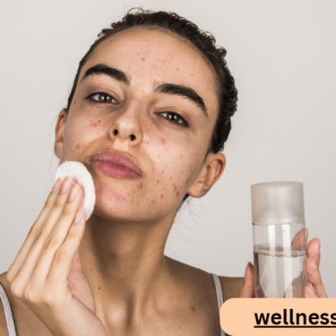 Choosing the Right Skin Care Products for Acne-Prone Skin