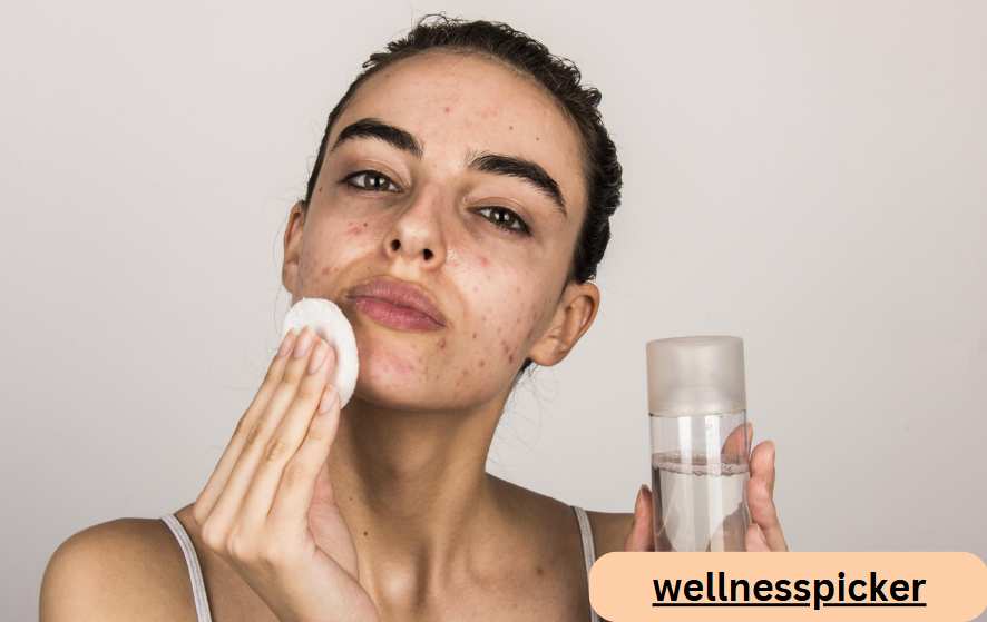 Choosing the Right Skin Care Products for Acne-Prone Skin