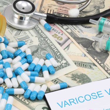 How Varicose Veins Affect Your Health