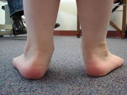 How to Spot and Treat Flat Feet in Children