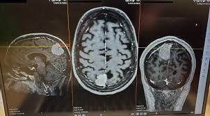 The Different Types of Brain Surgery