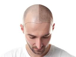 The Latest Treatments in Hair Loss Prevention