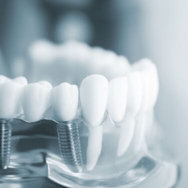 The Process of Getting a Dental Implant