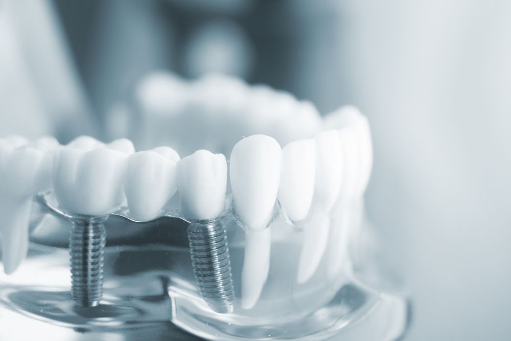 The Process of Getting a Dental Implant
