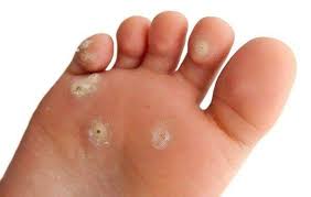 # Treatments for Warts