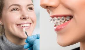 Veneers vs. Braces: Which Is Right for Your Smile?