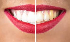 What Are the Most Popular Cosmetic Dentistry Treatments?