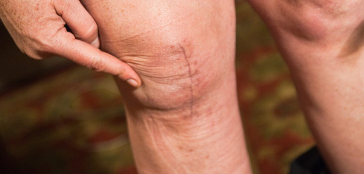 What Causes Arthritis?