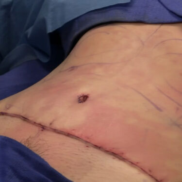 What to Expect During and After a Tummy Tuck Procedure