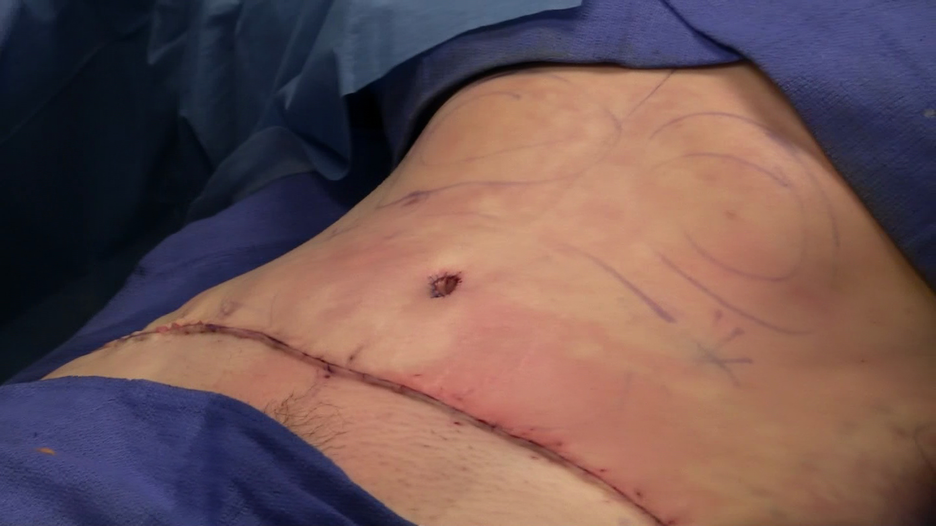 What to Expect During and After a Tummy Tuck Procedure