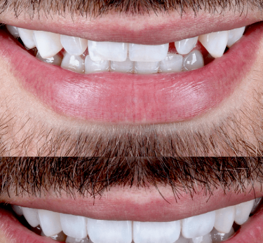 Whitening vs. Veneers: Which Cosmetic Dentistry Solution Is Right for You?