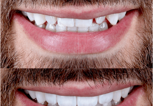 Whitening vs. Veneers: Which Cosmetic Dentistry Solution Is Right for You?