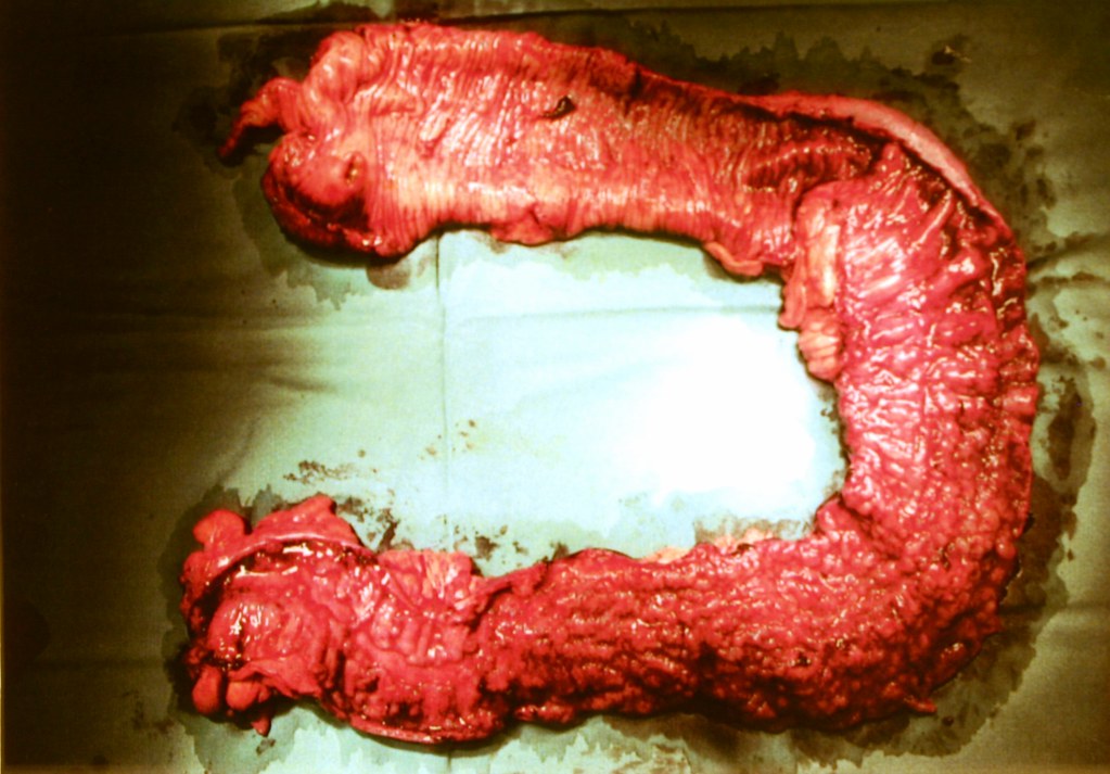 Treatments for Ulcerative Colitis